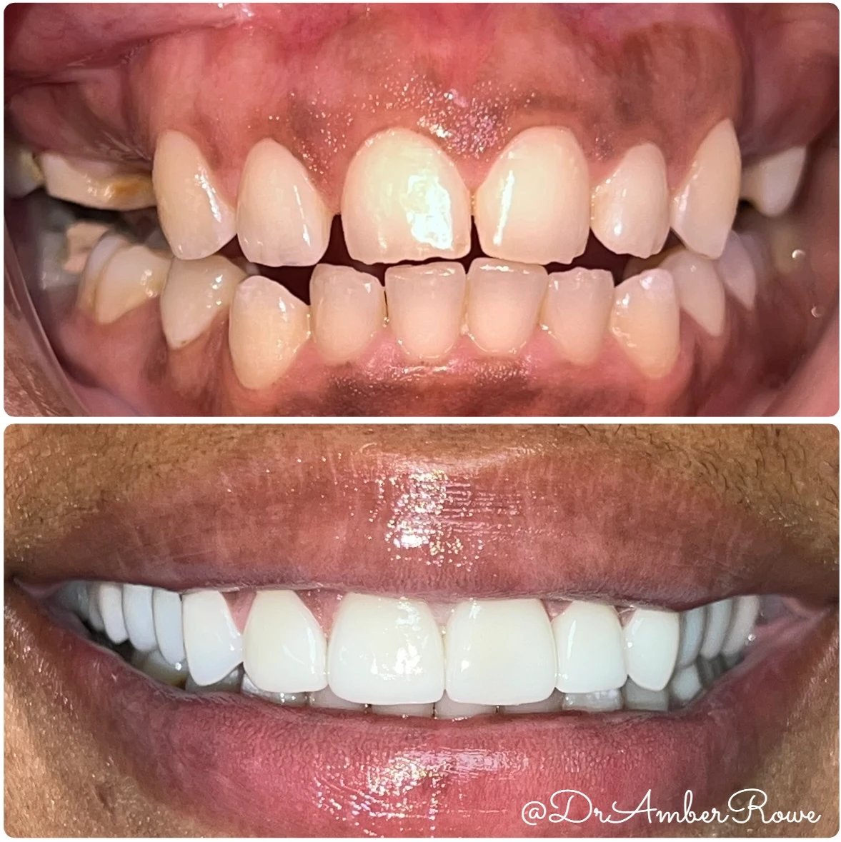 full-mouth-makeover gallery