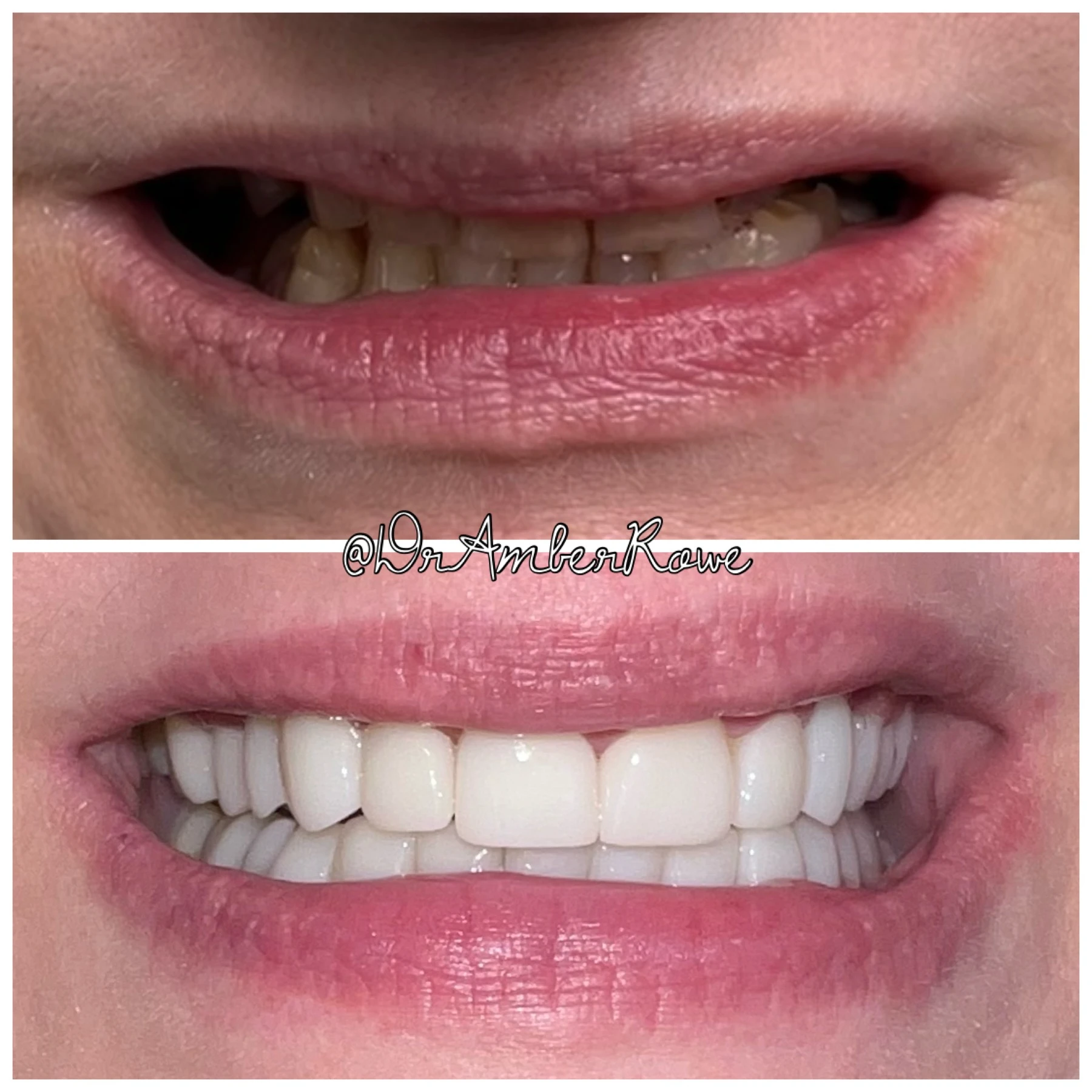 full-mouth-makeover gallery