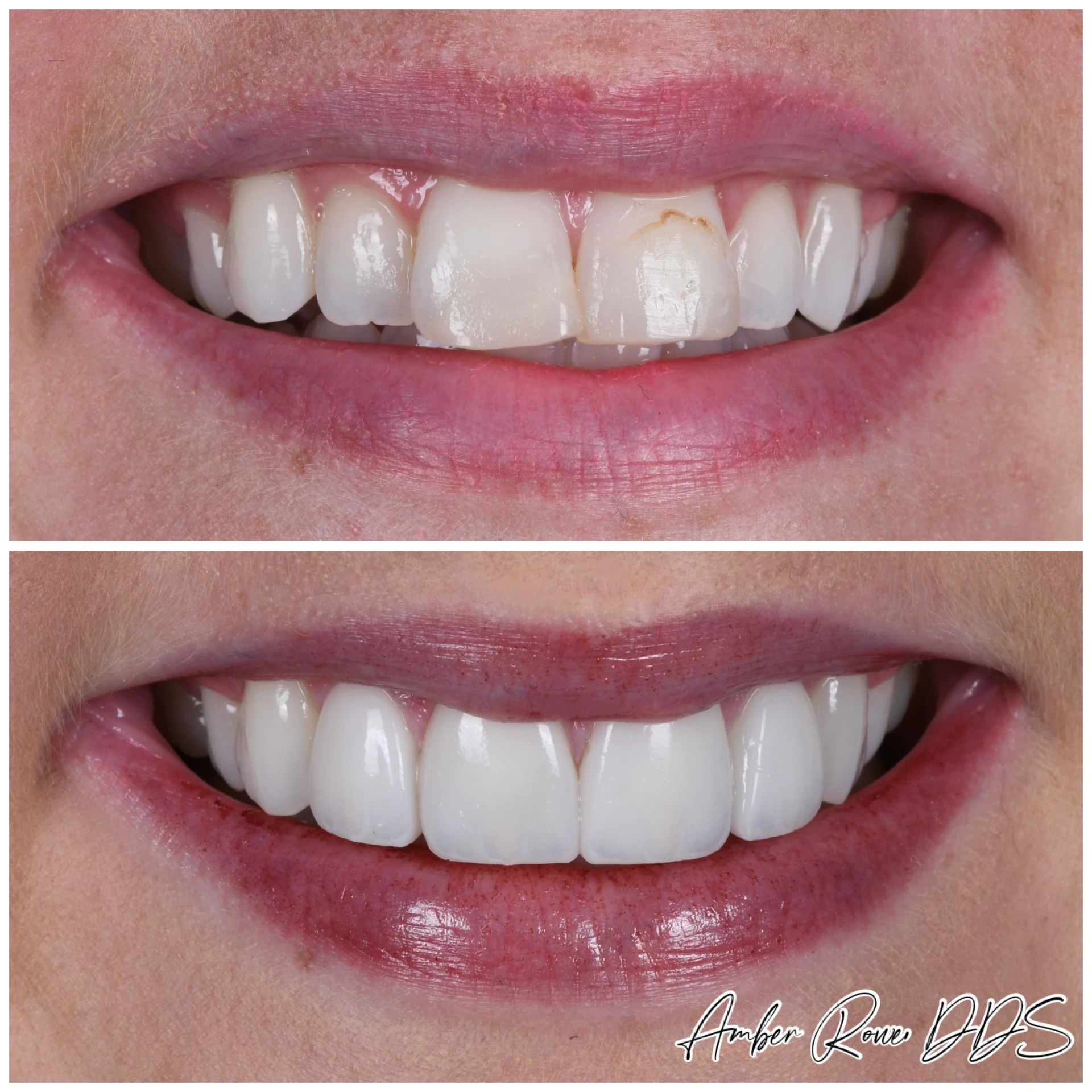veneers gallery