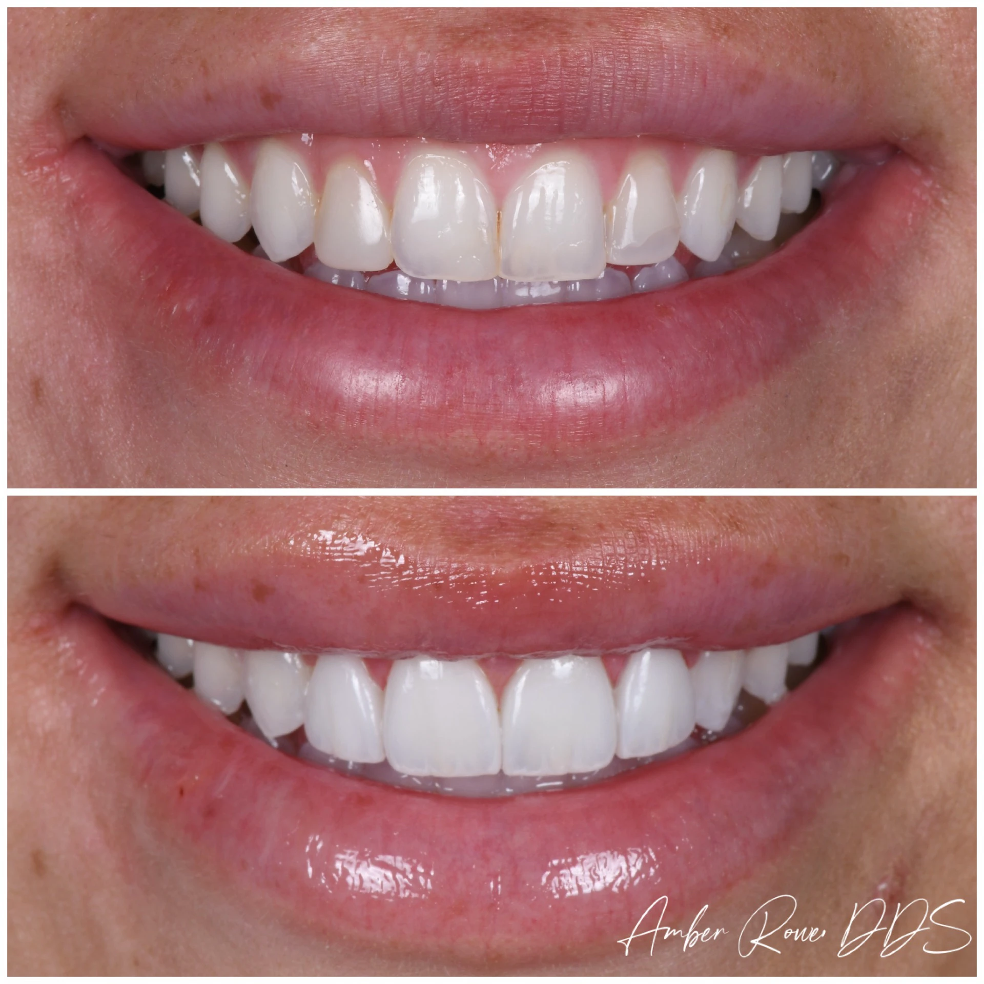 veneers gallery