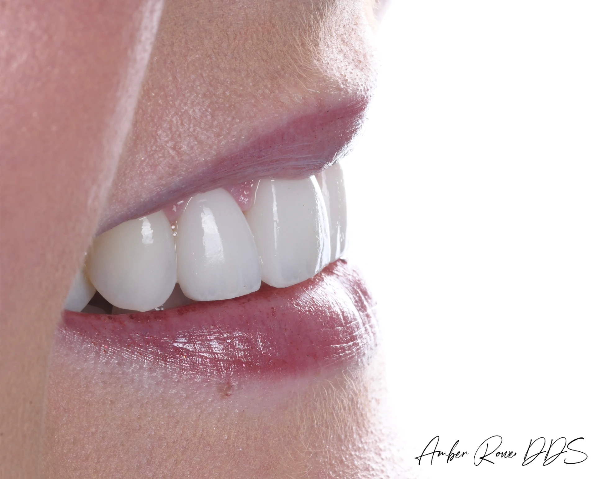 veneers gallery