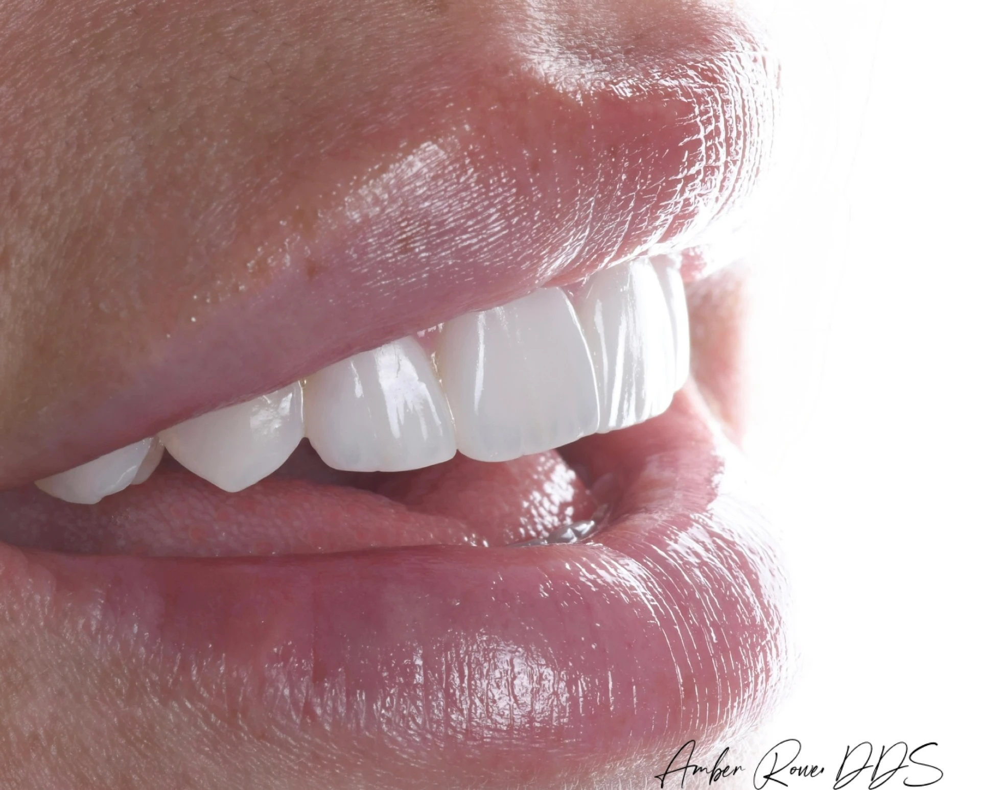 veneers gallery