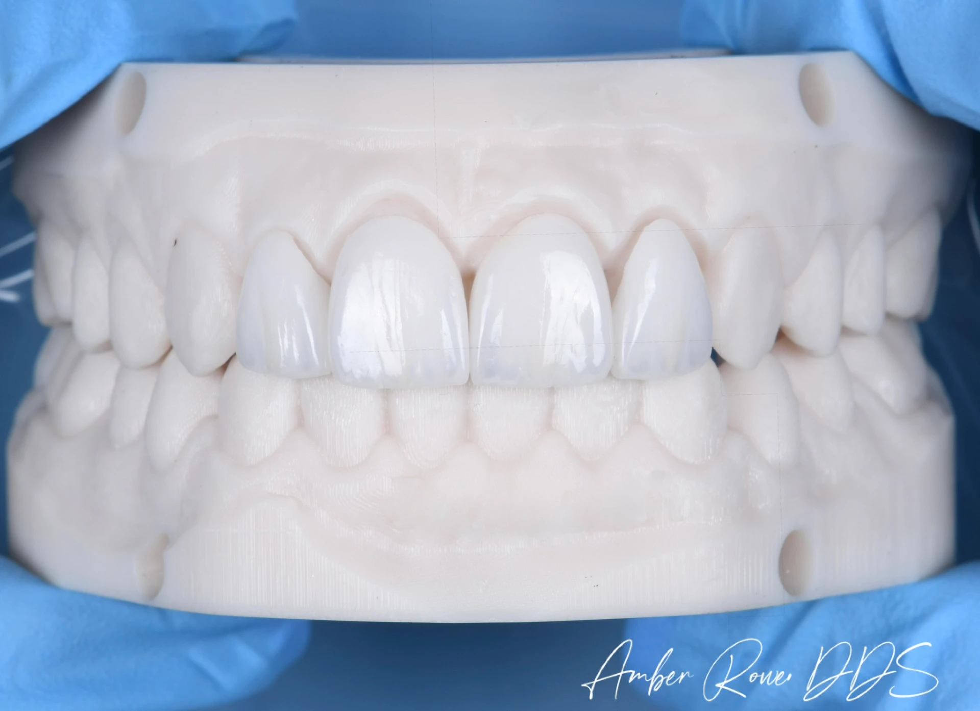 veneers gallery